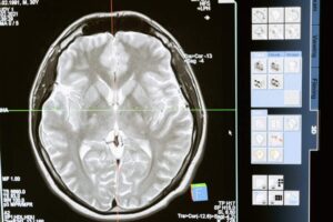 enfermedades-mentales-neurodegenerativas