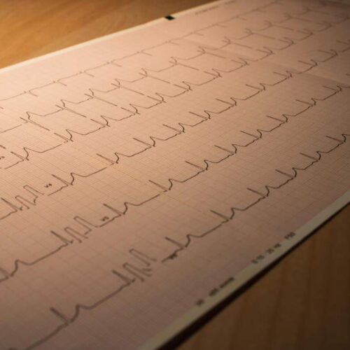 Qué debes saber sobre la insuficiencia cardíaca en ancianos