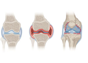 Gonalgia en personas mayores causas más frecuentes