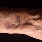 Hematomas Sin Golpes en Ancianos: Causas y tratamientos