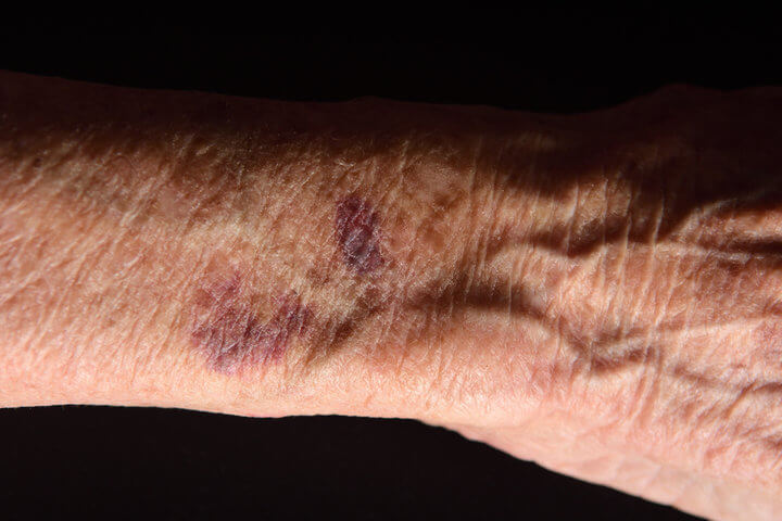 Hematomas Sin Golpes en Ancianos: Causas y tratamientos