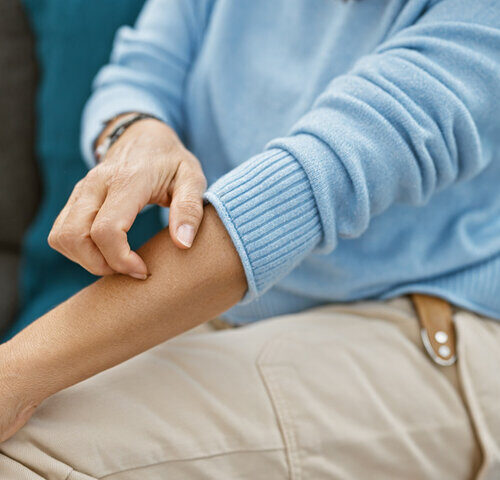 Herpes Zóster en Adultos Mayores: Secuelas y tratamiento