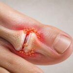 Enfermedad-de-gota-en-personas-mayores